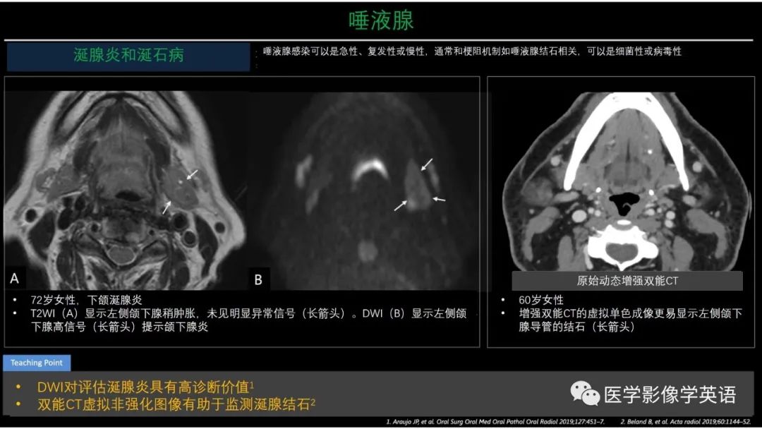 影像PPT - 【PPT】头颈部感染影像学进展-56 影像PPT - 【PPT】头颈部感染影像学进展-56