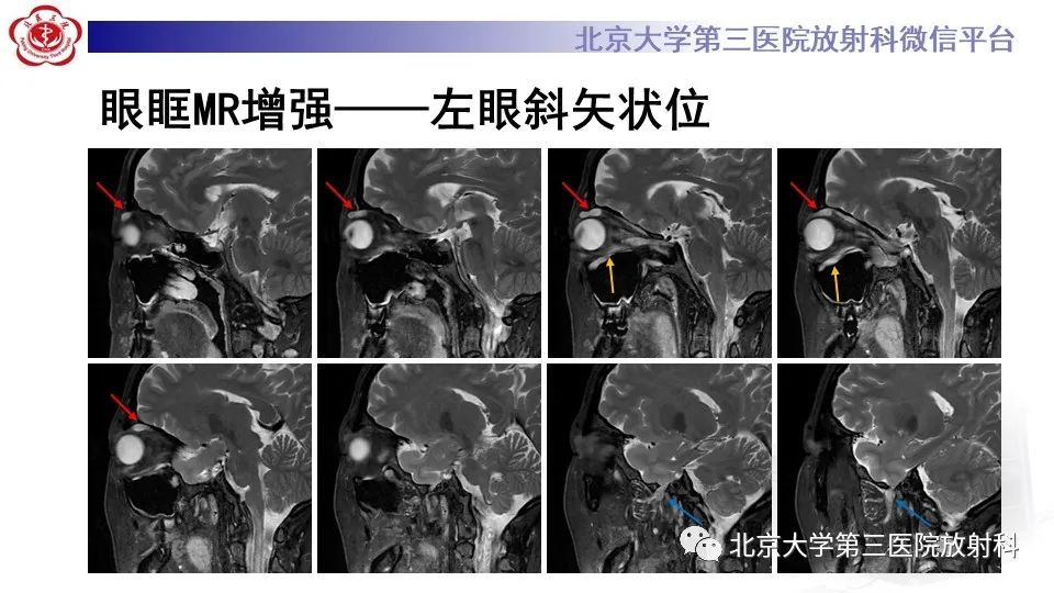 影像PPT - 【PPT】神经束脑膜瘤-3