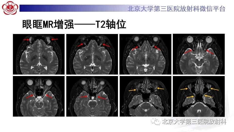 影像PPT - 【PPT】神经束脑膜瘤-5