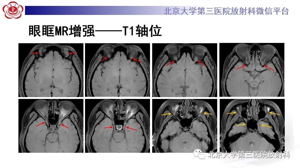 影像PPT - 【PPT】神经束脑膜瘤-6