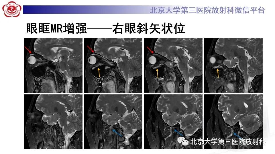 影像PPT - 【PPT】神经束脑膜瘤-4
