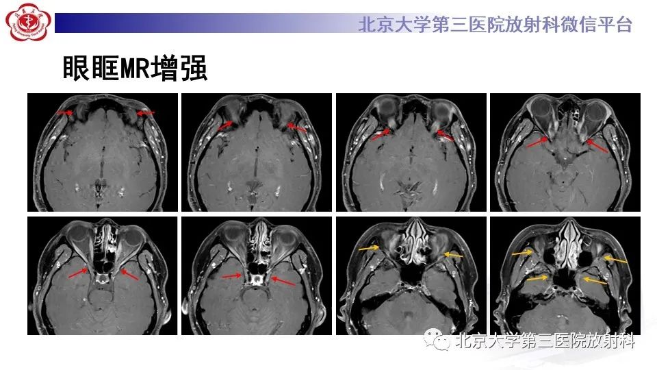 影像PPT - 【PPT】神经束脑膜瘤-7