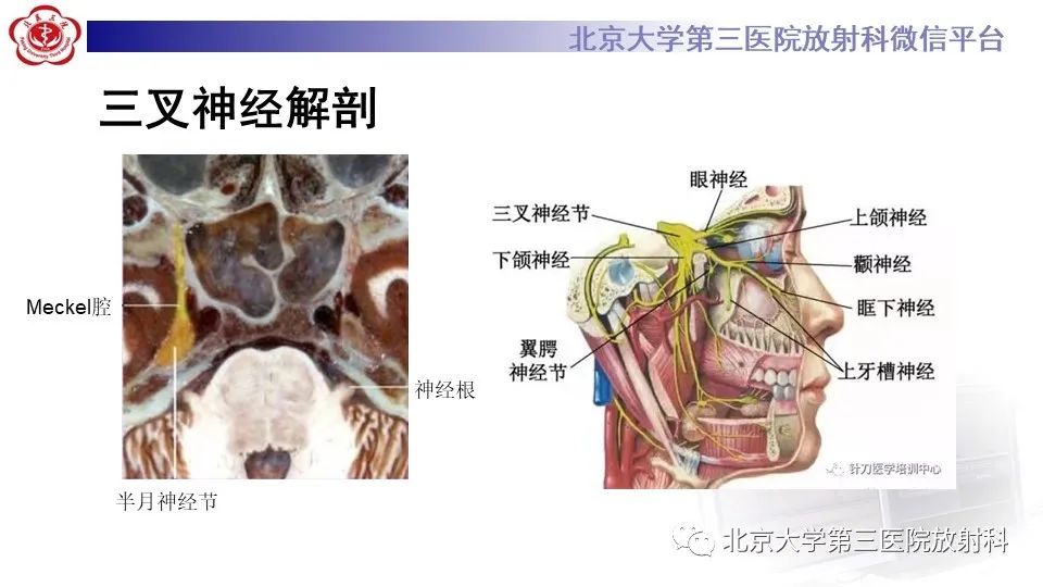 影像PPT - 【PPT】神经束脑膜瘤-8