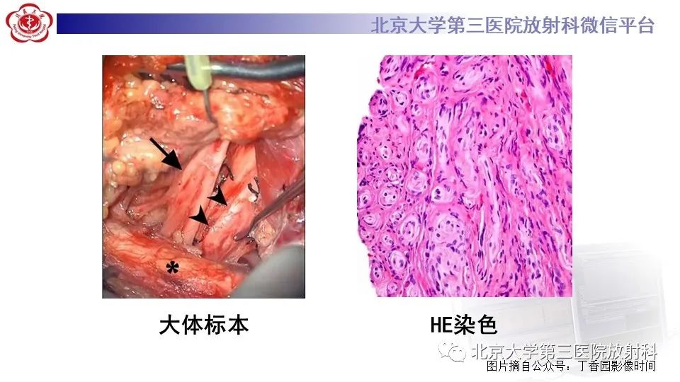影像PPT - 【PPT】神经束脑膜瘤-19