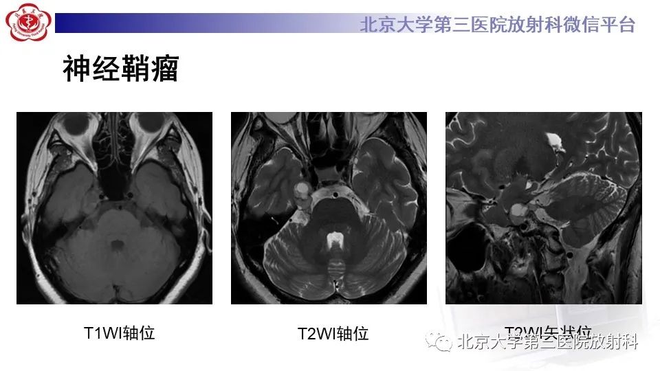 影像PPT - 【PPT】神经束脑膜瘤-23