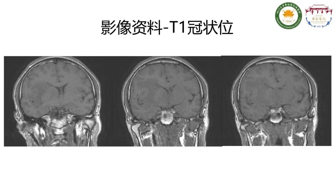 影像PPT - 【病例】IgG4相关性肥厚性硬脑膜炎-3