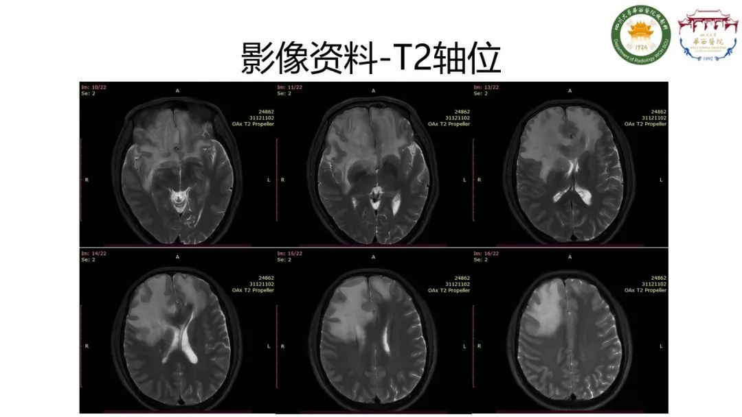 影像PPT - 【病例】IgG4相关性肥厚性硬脑膜炎-4