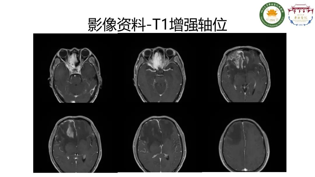 影像PPT - 【病例】IgG4相关性肥厚性硬脑膜炎-6