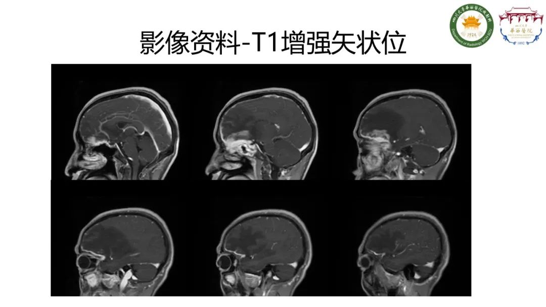影像PPT - 【病例】IgG4相关性肥厚性硬脑膜炎-7