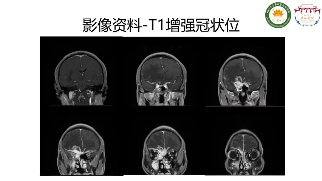 影像PPT - 【病例】IgG4相关性肥厚性硬脑膜炎-8