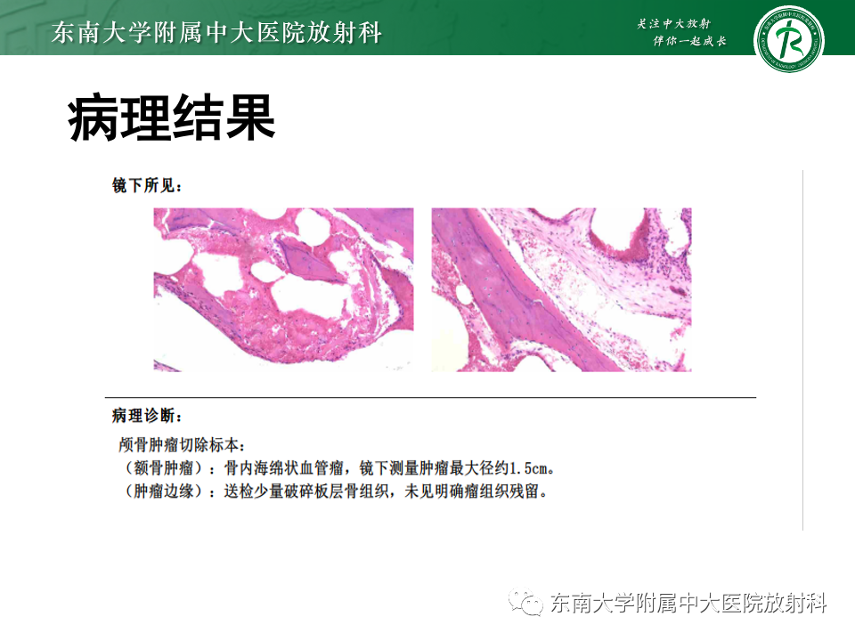 影像PPT - 【PPT】原发性颅骨海绵状血管瘤-2