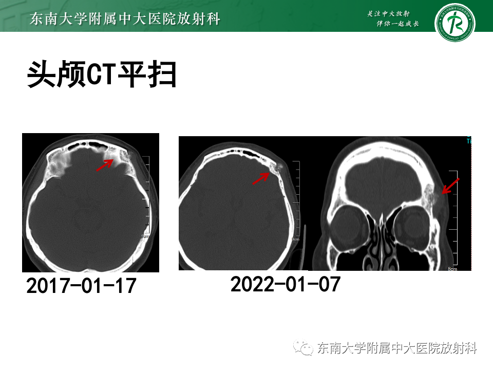 影像PPT - 【PPT】原发性颅骨海绵状血管瘤-10