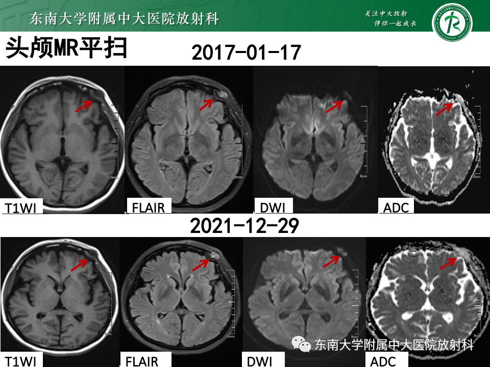 影像PPT - 【PPT】原发性颅骨海绵状血管瘤-11