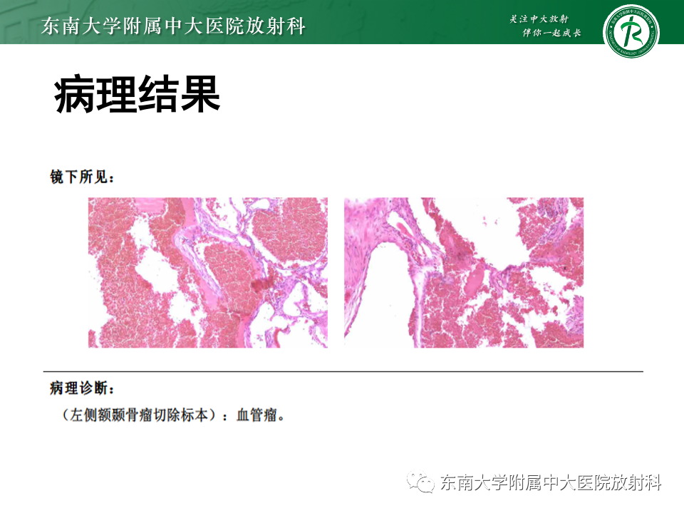 影像PPT - 【PPT】原发性颅骨海绵状血管瘤-12