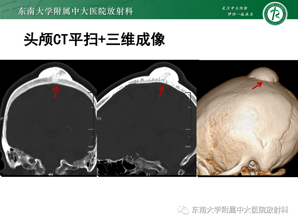 影像PPT - 【PPT】原发性颅骨海绵状血管瘤-15