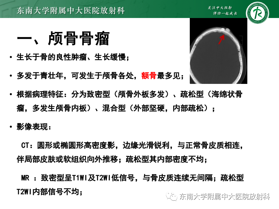 影像PPT - 【PPT】原发性颅骨海绵状血管瘤-17