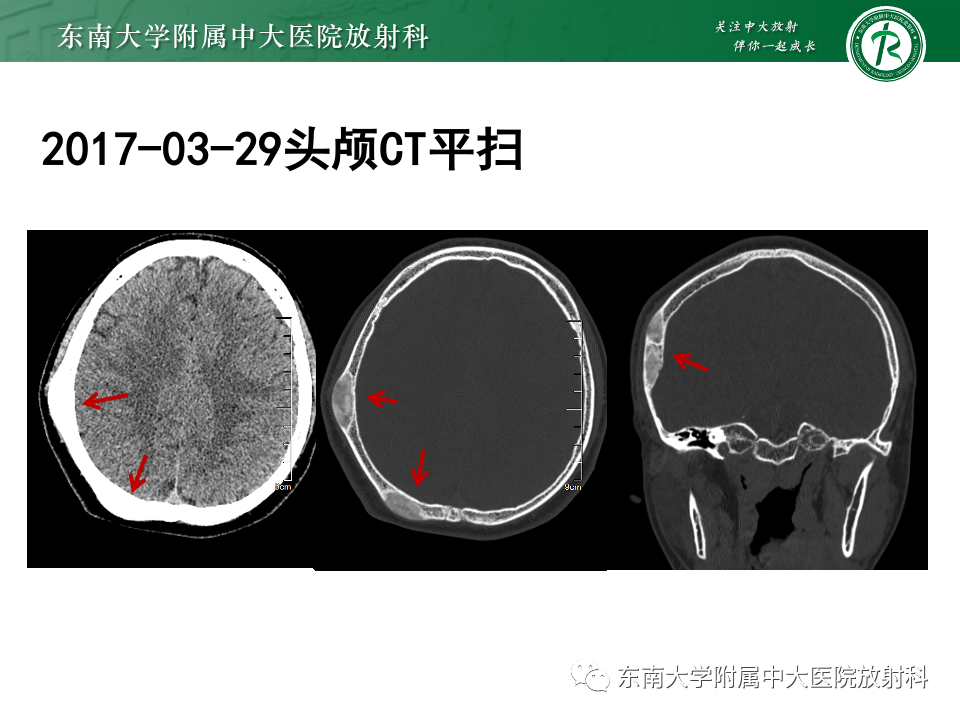 影像PPT - 【PPT】原发性颅骨海绵状血管瘤-19