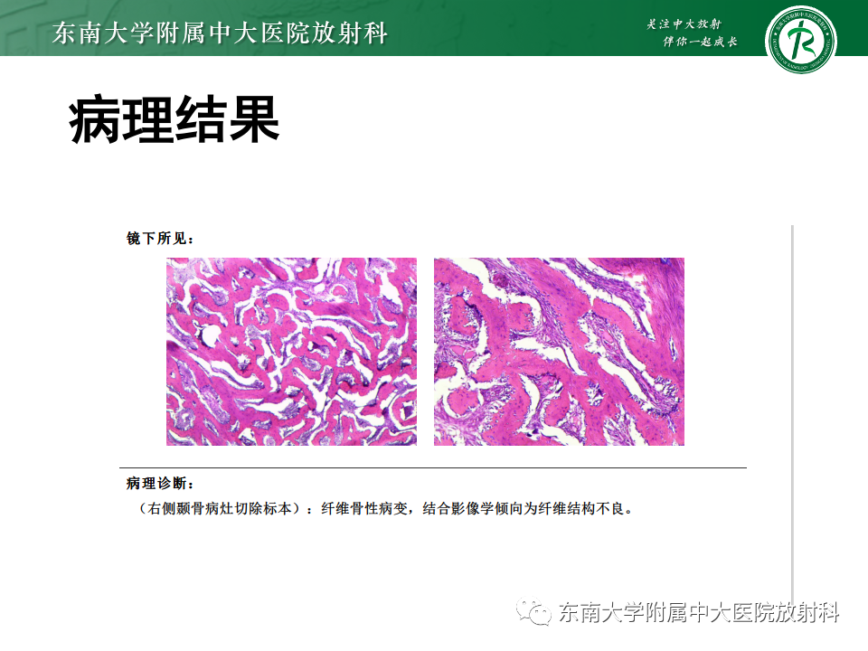 影像PPT - 【PPT】原发性颅骨海绵状血管瘤-20