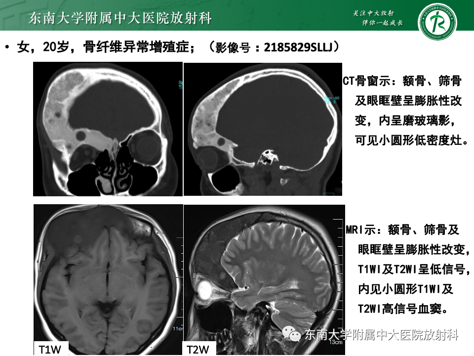 影像PPT - 【PPT】原发性颅骨海绵状血管瘤-22