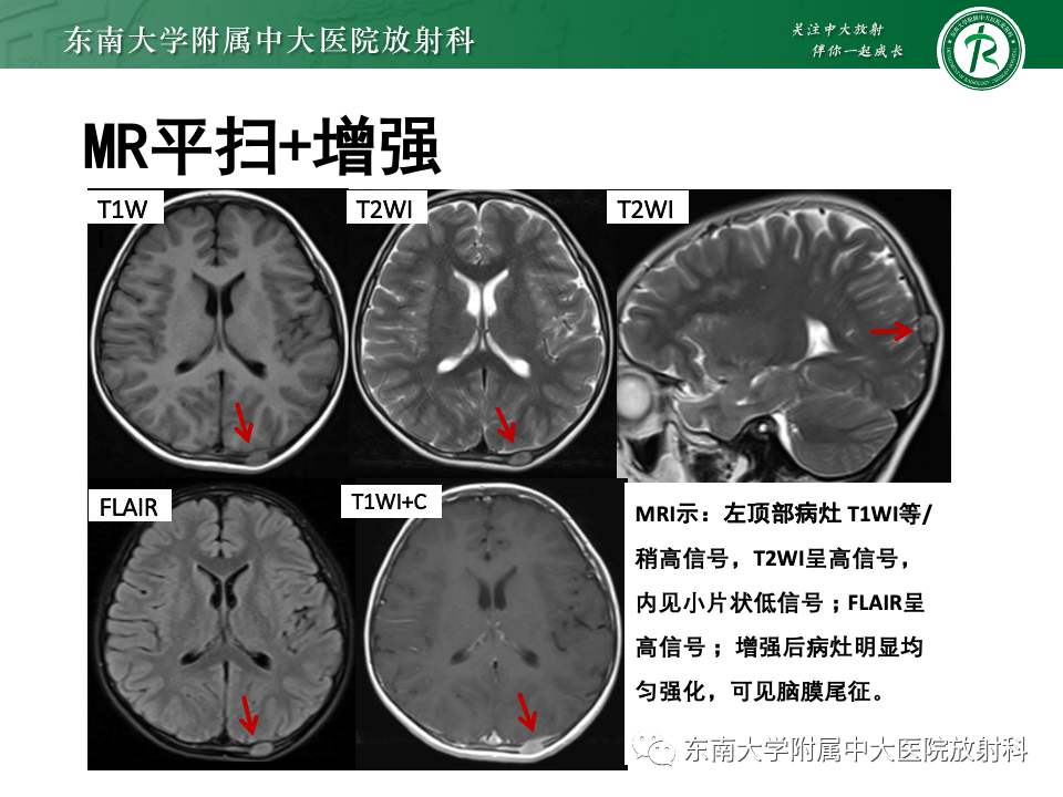 影像PPT - 【PPT】原发性颅骨海绵状血管瘤-24