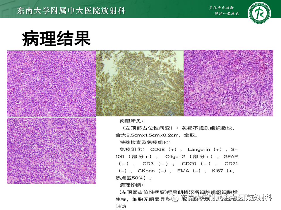影像PPT - 【PPT】原发性颅骨海绵状血管瘤-25
