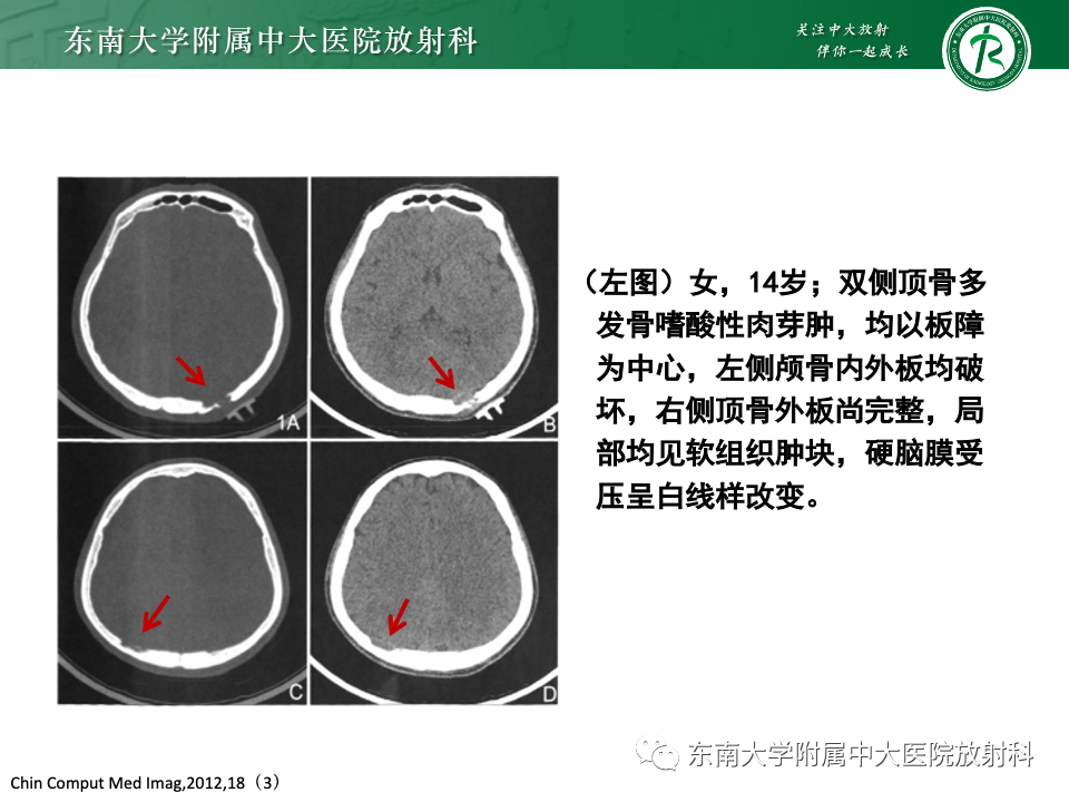 影像PPT - 【PPT】原发性颅骨海绵状血管瘤-28