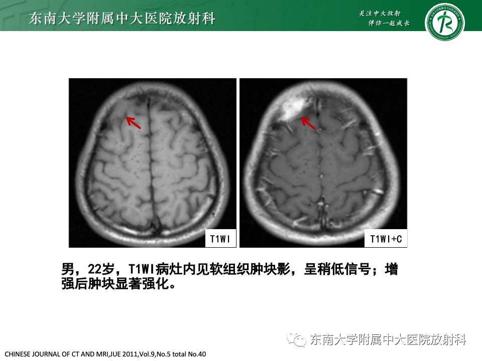 影像PPT - 【PPT】原发性颅骨海绵状血管瘤-29