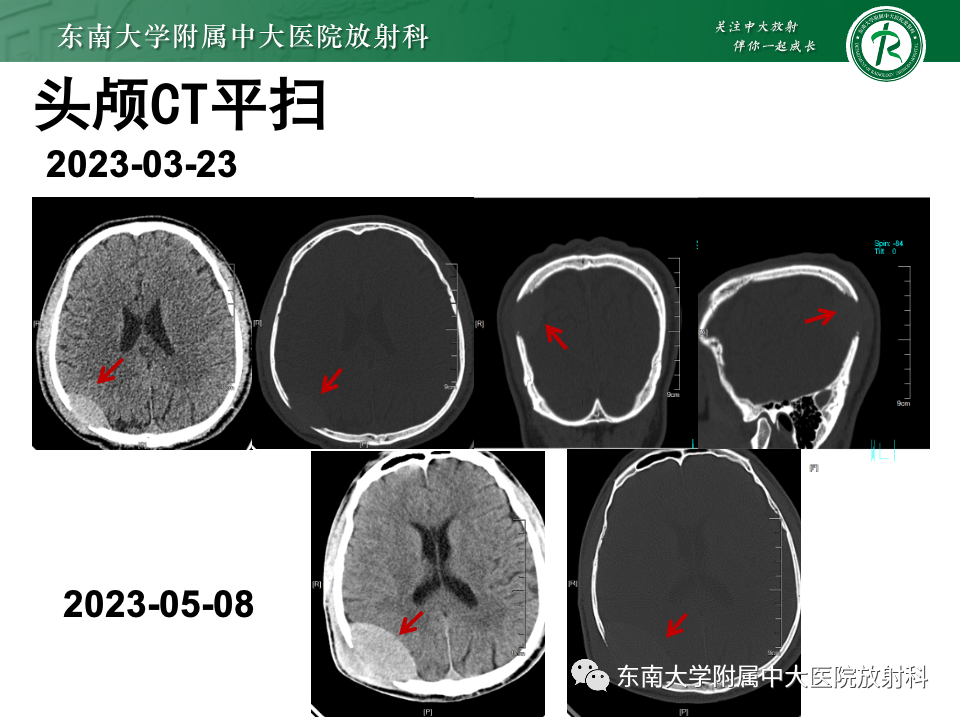 影像PPT - 【PPT】原发性颅骨海绵状血管瘤-31