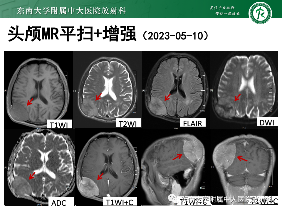 影像PPT - 【PPT】原发性颅骨海绵状血管瘤-32
