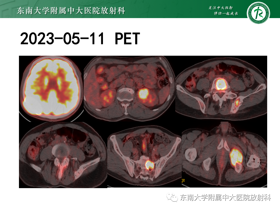 影像PPT - 【PPT】原发性颅骨海绵状血管瘤-33