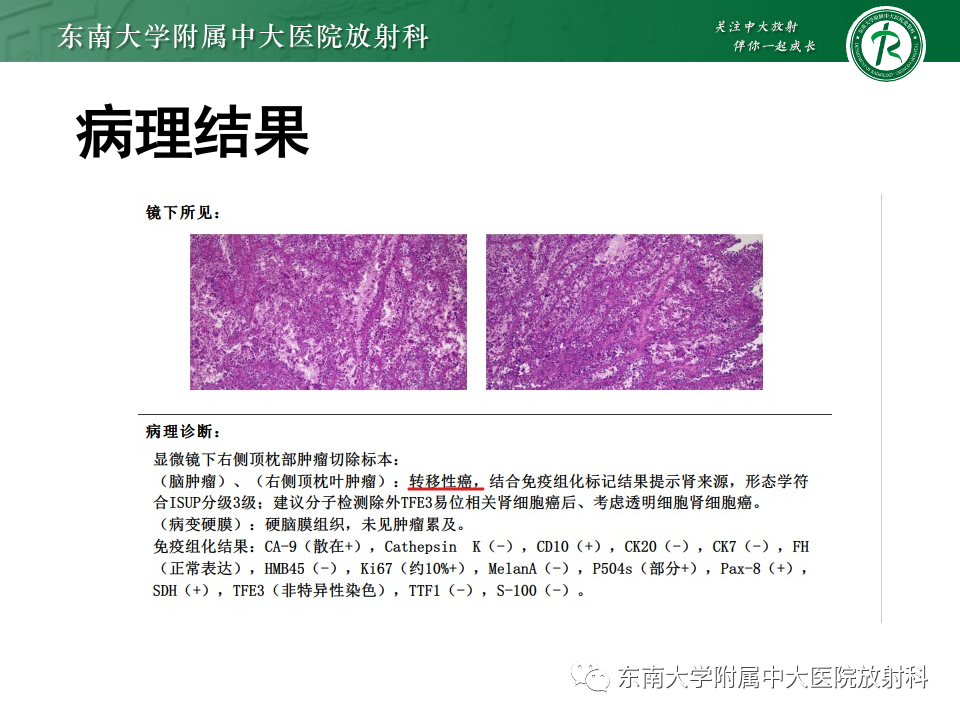 影像PPT - 【PPT】原发性颅骨海绵状血管瘤-34
