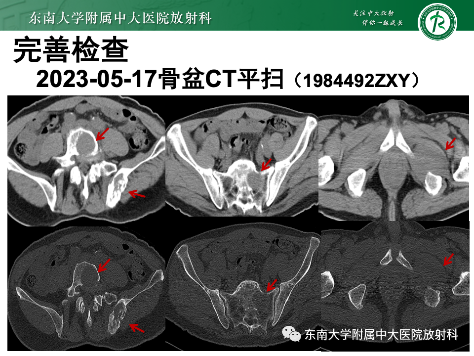影像PPT - 【PPT】原发性颅骨海绵状血管瘤-35