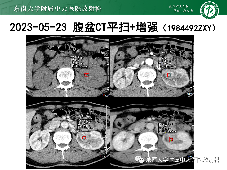 影像PPT - 【PPT】原发性颅骨海绵状血管瘤-36