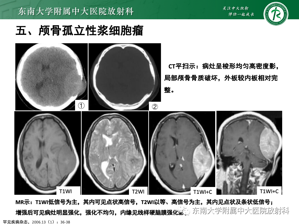 影像PPT - 【PPT】原发性颅骨海绵状血管瘤-38