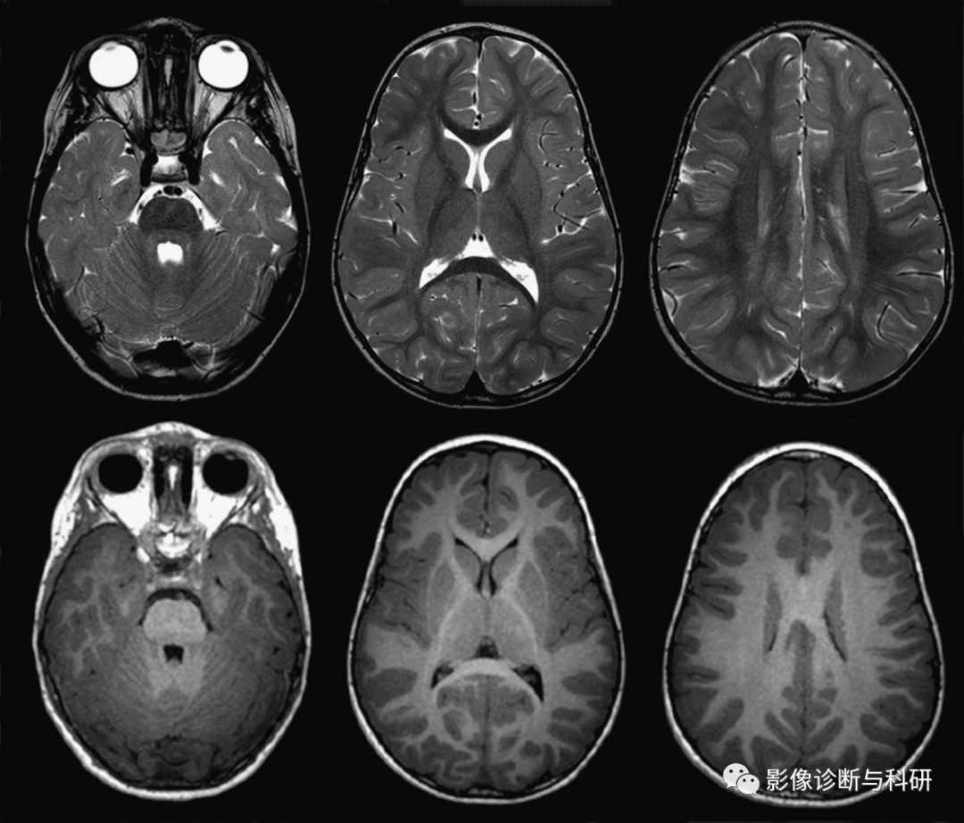 影像PPT - 新生儿正常髓鞘化进程-8 影像PPT - 新生儿正常髓鞘化进程-8