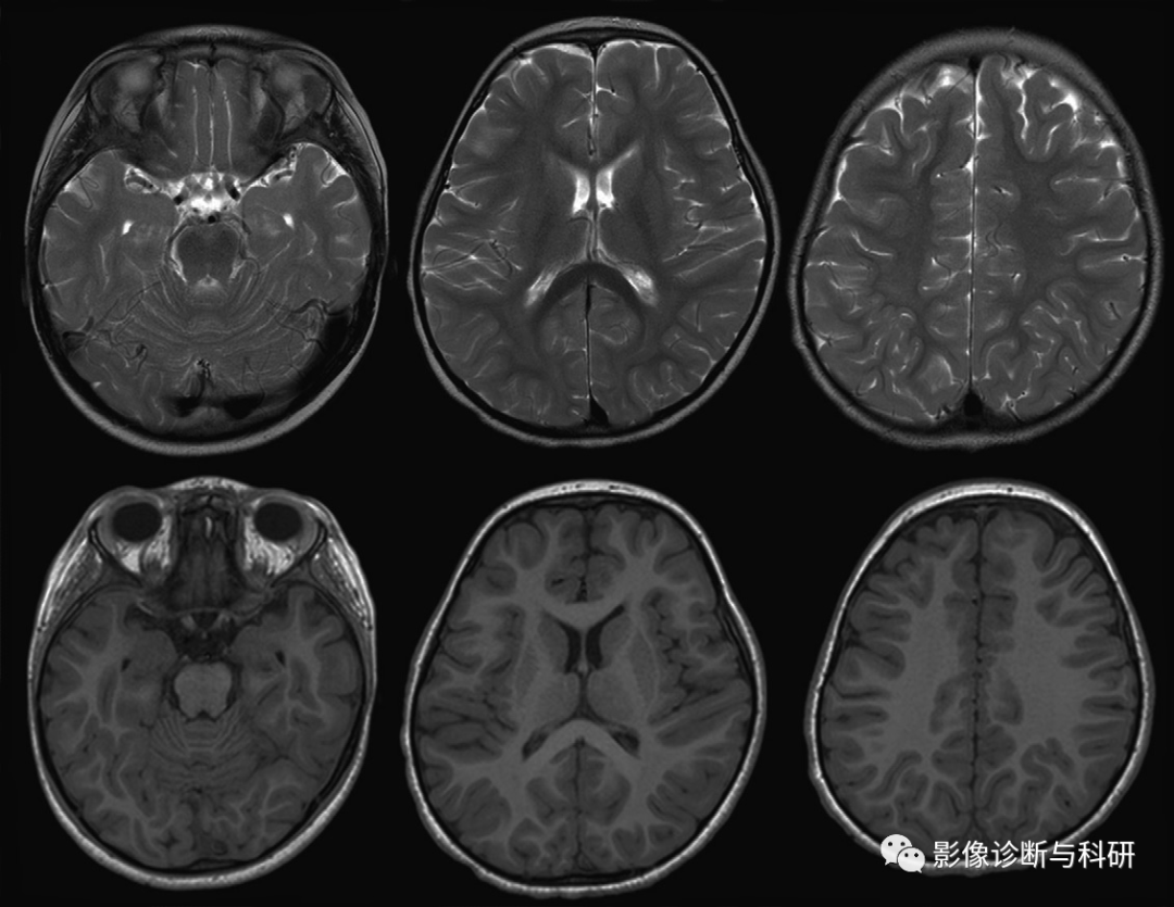 影像PPT - 新生儿正常髓鞘化进程-9 影像PPT - 新生儿正常髓鞘化进程-9
