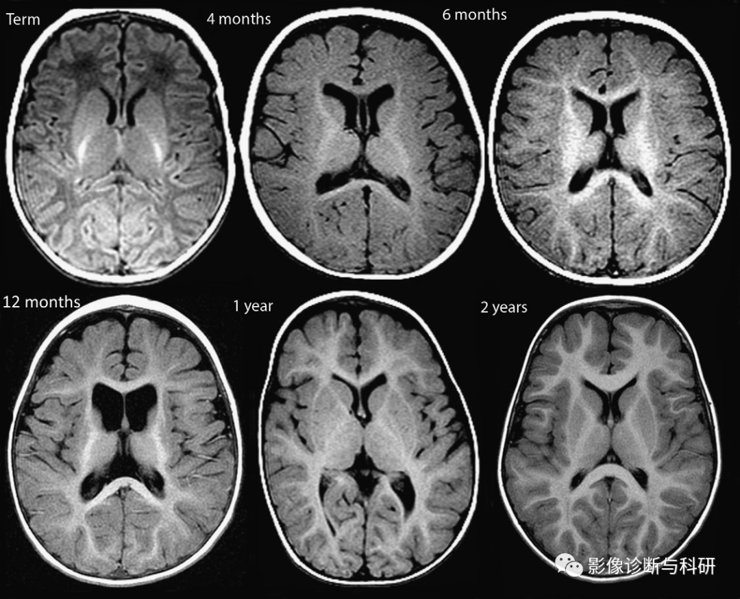 影像PPT - 新生儿正常髓鞘化进程-12 影像PPT - 新生儿正常髓鞘化进程-12