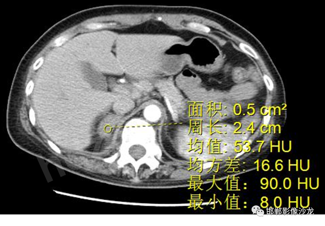 影像PPT - 【PPT】肾上腺结核-4