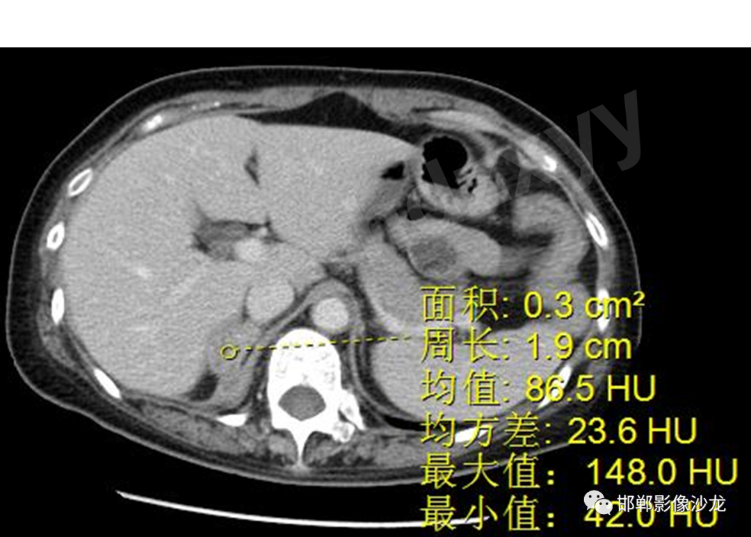 影像PPT - 【PPT】肾上腺结核-6