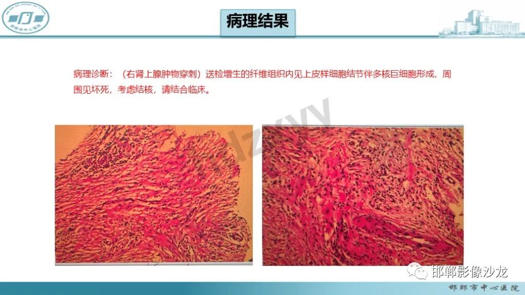 影像PPT - 【PPT】肾上腺结核-18