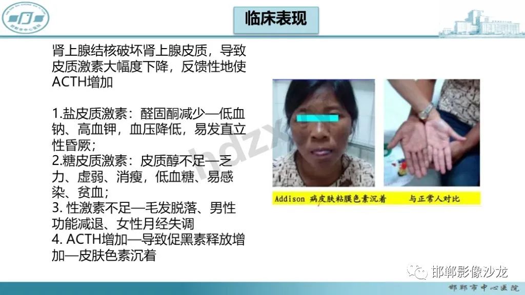 影像PPT - 【PPT】肾上腺结核-24