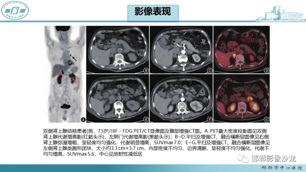 影像PPT - 【PPT】肾上腺结核-28