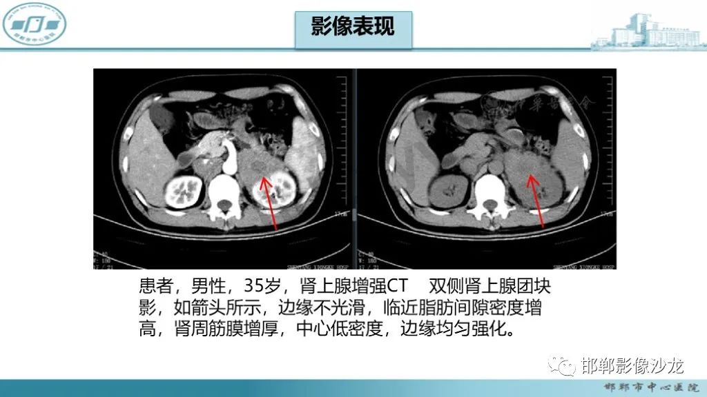 影像PPT - 【PPT】肾上腺结核-29