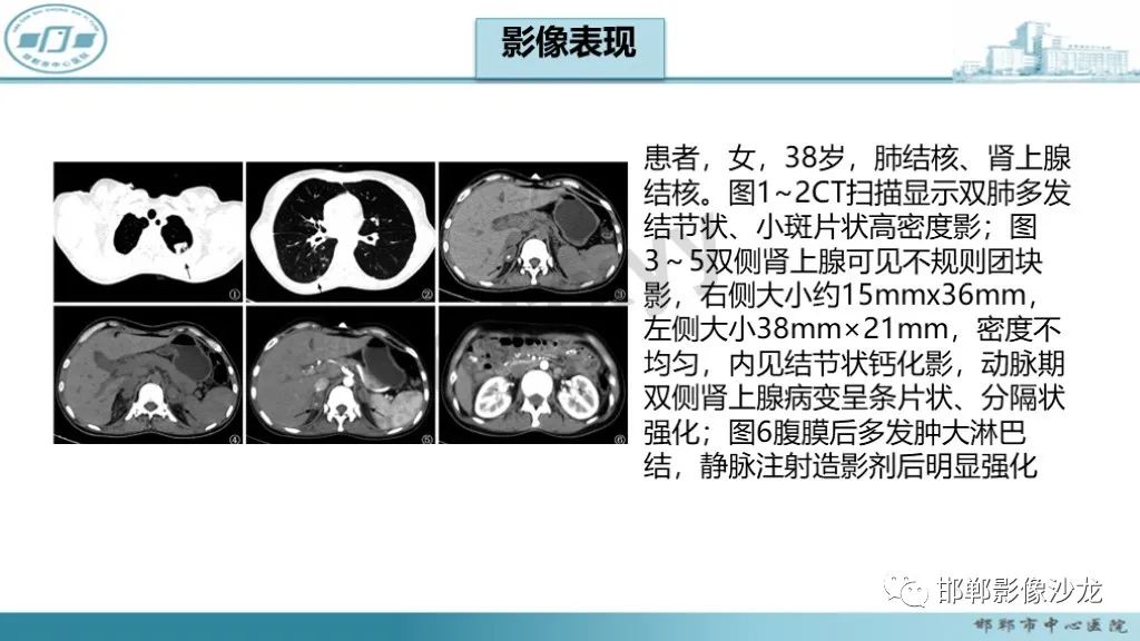 影像PPT - 【PPT】肾上腺结核-30