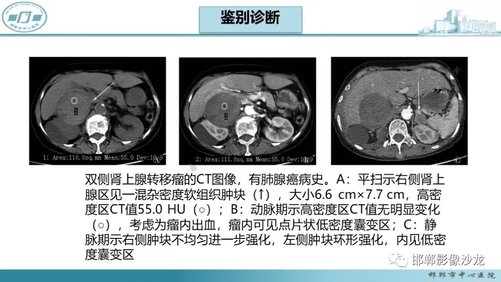 影像PPT - 【PPT】肾上腺结核-34