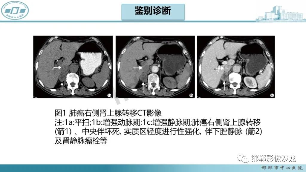 影像PPT - 【PPT】肾上腺结核-35