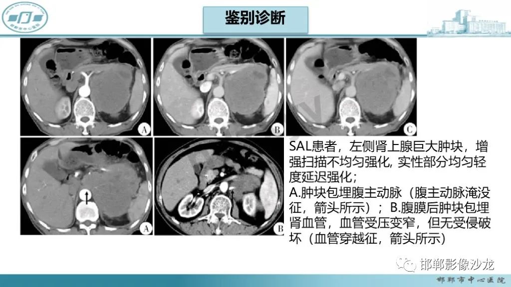 影像PPT - 【PPT】肾上腺结核-38
