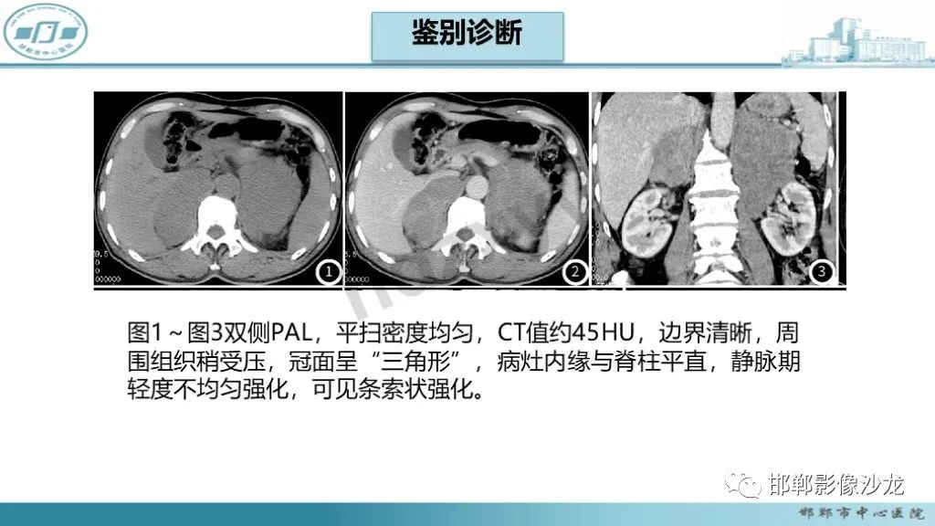 影像PPT - 【PPT】肾上腺结核-39