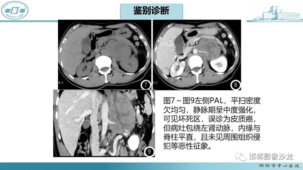 影像PPT - 【PPT】肾上腺结核-40