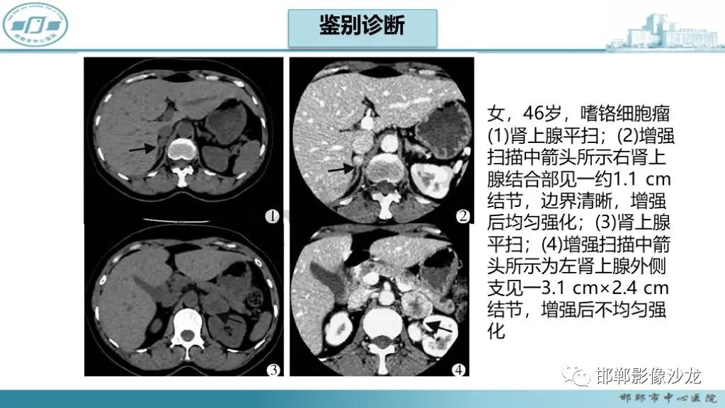 影像PPT - 【PPT】肾上腺结核-42